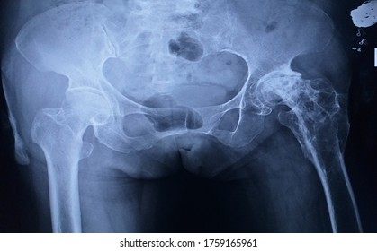 X-ray Both Hips AP Show Old Fracture Left Proximal Femur With Osteoporoiss And Coarse Trabeculations.Flattening Of Left Femoral Head And OA Change Of Left Hip Joint.Medical Healthcare Image Concept.