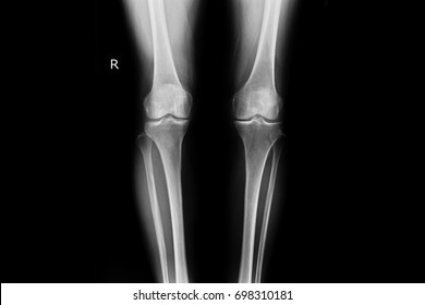 Xray both knee show osteoarthritis left knee