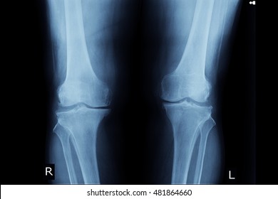 Xray Both Knee Show Osteoporosis