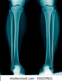 x-ray both leg show normal alignment