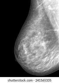 Xray Breast Stock Photo 241565335 | Shutterstock