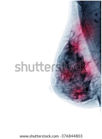 X-ray: Breast Cancer (Mamary tumor)