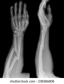 Xray Of Broken Arm