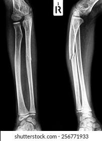 Xray Of Broken Arms