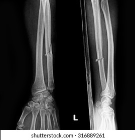 Xray Of Broken Arms