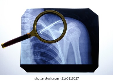 X-ray Broken Collarbone And Spoke Inserted Into It