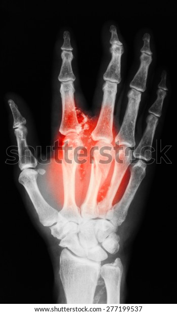 Xray Broken Hand Pa View Show Stock Photo (Edit Now) 277199537