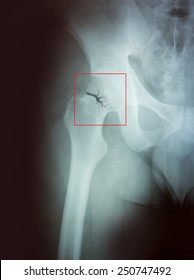 X-ray Of A Broken Hip