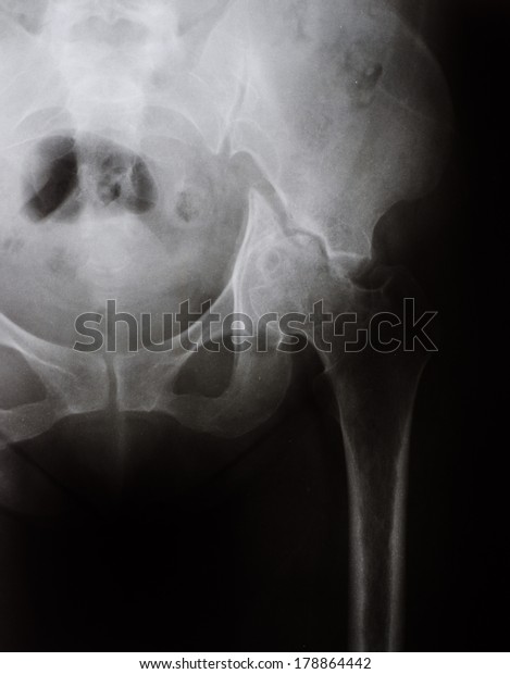 Hip Pelvic Fracture