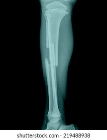 X-ray of broken leg