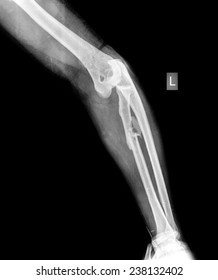 Xray Of Broken Leg