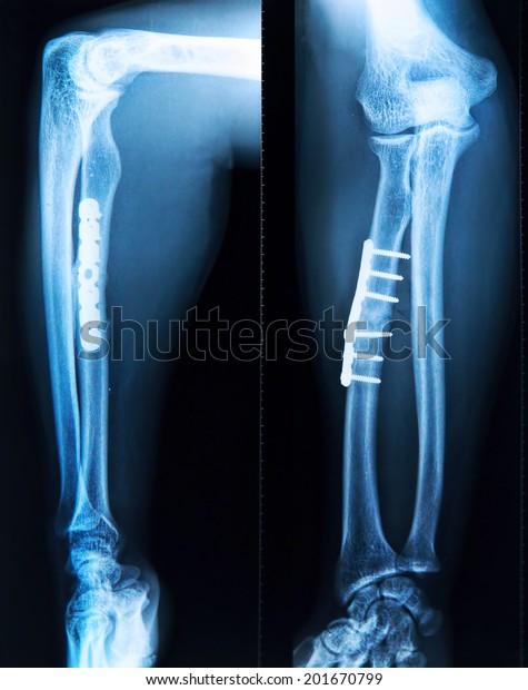 Xray Broken Tibia Screw Fixation Surgery Stock Photo (Edit Now) 201670799