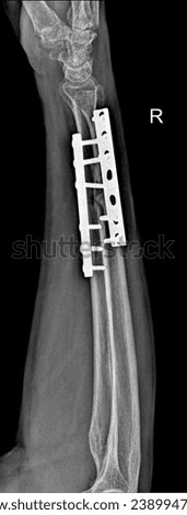 X-ray capturing a fracture of both the radius and ulna fixation providing a detailed view of the forearm. 