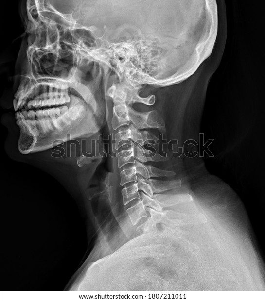 X-ray of cervical\
spine in lateral position