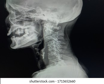 cervical spine levels x ray