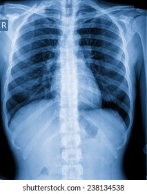 Xray Of Chest