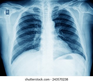 Xray Of Chest