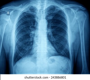 Xray Of Chest