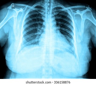 Similar Images, Stock Photos & Vectors of X-Ray Image Of Human Chest