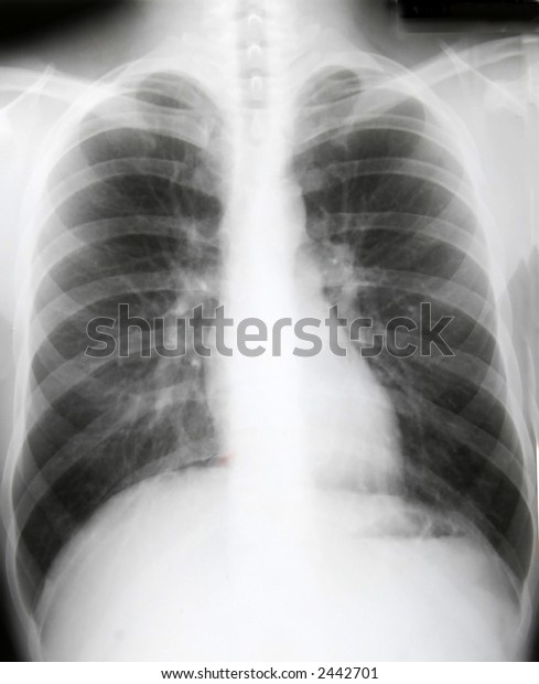 Xray Chest Healthy Patient Stock Photo (Edit Now) 2442701