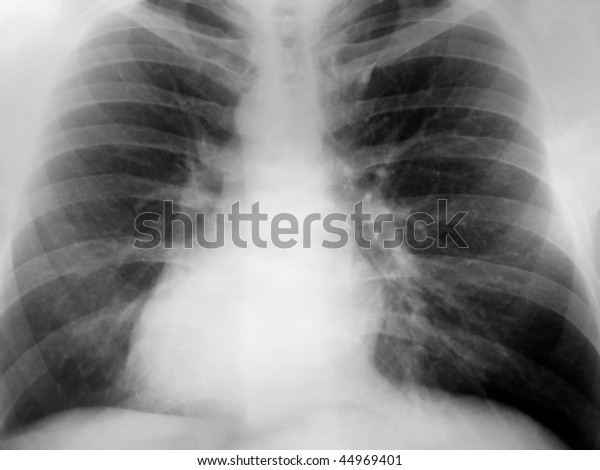 Xray Chest Positive Exposure Showing Dextrocardia Stock Photo (Edit Now ...