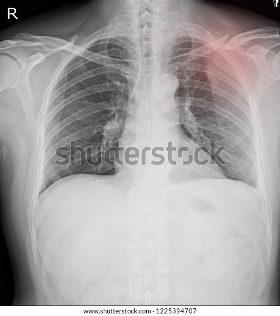 Xray Chest Showing Fractures Left Clavicle Stock Photo 1225394707 ...