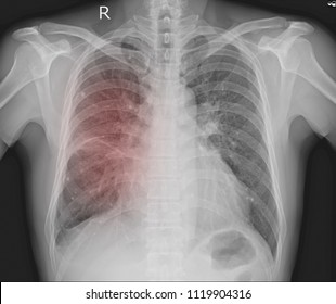 Chest Xray 2 Views Showing Normal Stock Photo (Edit Now) 1245115498