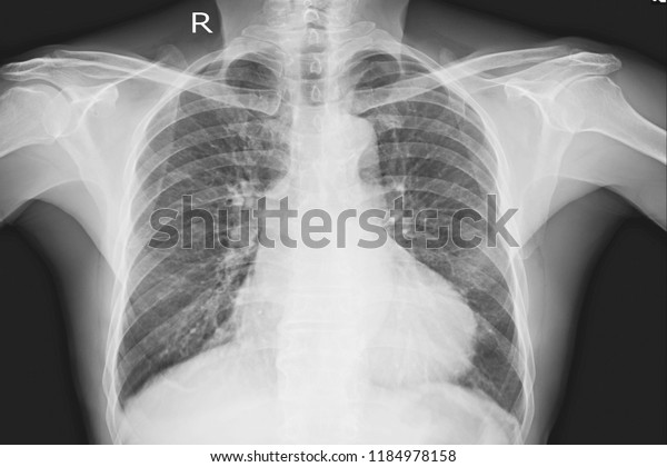 Xray Chest Upright Male 76 Year Stock Photo (Edit Now) 1184978158