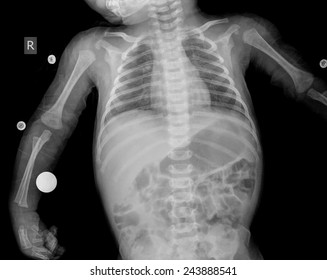 Xray Of Child Obdomen Chest