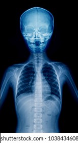 X-ray Child Upper Part Of Body, Hight Quality Film Of Child