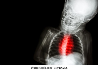 X-ray Child's Body With 