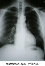 Xray Of Chronic Obstructive Pulmonary Disease (COPD) With Lung Cancer In The Right Lung