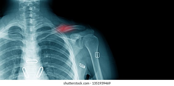 Film Xray Show Fracture Proximal Phalange Foto Stok Shutterstock