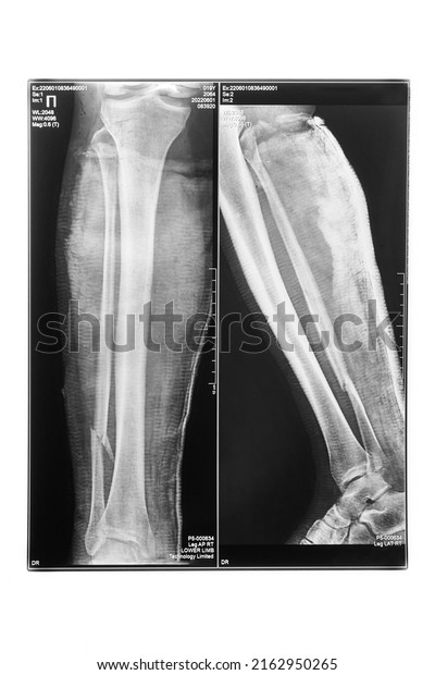 X-ray of a comminuted fracture of the lower leg\
with displacement and in two projections, on a white background.\
vertical image.