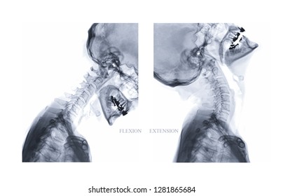 X-ray C-spine or x-ray image of Cervical spine Lateral Flexion and extension view for diagnostic intervertebral disc herniation.