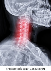 X-ray C-spine Or X-ray Image Of Cervical Spine Oblique View For Diagnostic Intervertebral Disc Herniation.