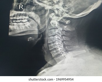 X-ray C-spine lateral views finding suspected fracture lateral mass of C1 vertebra with widening of anterior atlantodental interval(ADI) and mild compression fracture of C6 vertebra