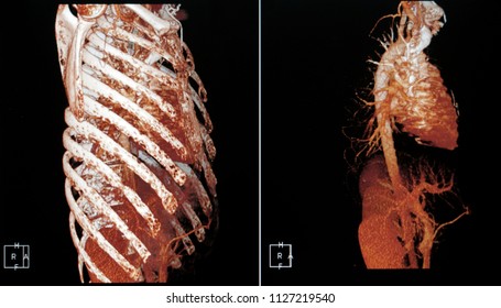 X-ray CT Scan, CTA  Aorta 3D Bone                             