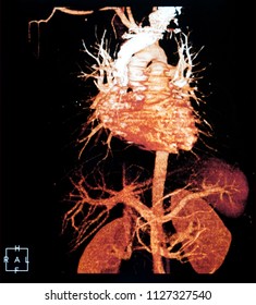 X-ray CT Scan, CTA  Aorta 3D                              