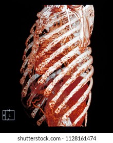   X-ray CT Scan, CTA Aorta 3D Bone                             