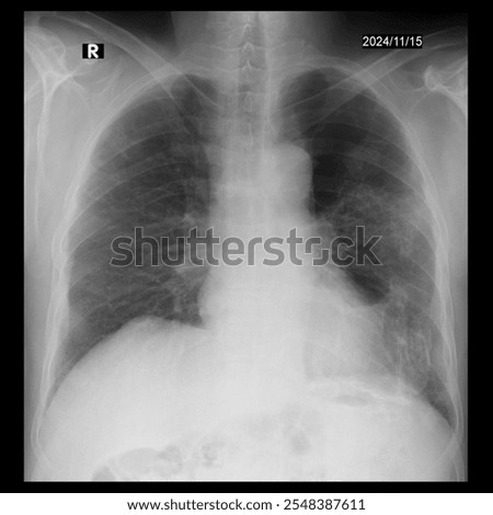 The X-ray demonstrates multiple irregularly shaped densities throughout both hemithoraces. These are consistent with calcified pleural plaques and indicate past asbestos exposure. 
