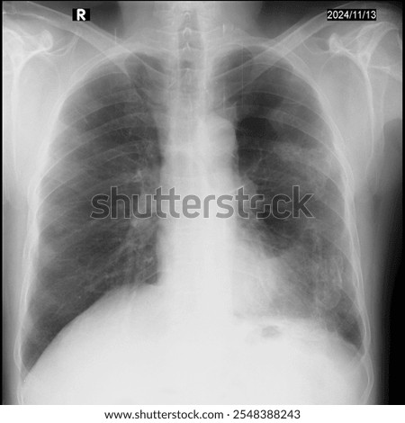 The X-ray demonstrates multiple irregularly shaped densities throughout both hemithoraces. These are consistent with calcified pleural plaques and indicate past asbestos exposure. 