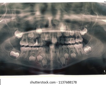 X-ray Dentist Milk Teeth 7 Years Child