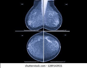 Mammography Breast Scan Xray Imagewomens Health Stock Photo (Edit Now ...