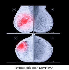  X-ray Digital Mammogram both side CC view and MLO . mammography or breast scan for Breast cancer showing BI-RADS 4 Suspicious.
