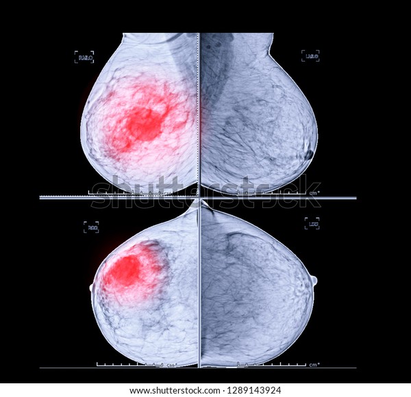 Xray Digital Mammogram Both Side Cc Stock Photo Edit Now