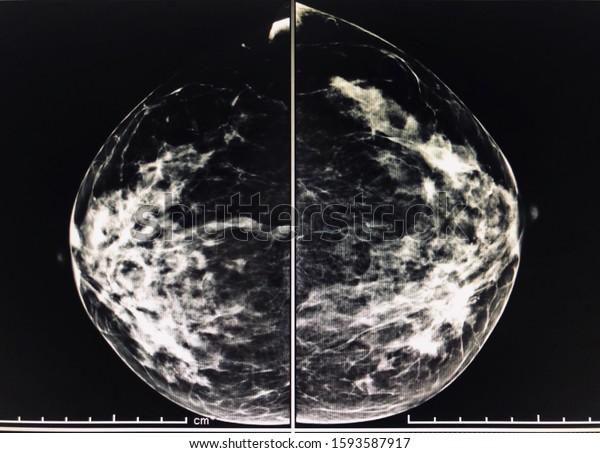 X-ray Digital\
Mammogram or mammography is x-ray image of the breast in women for\
screening Breast cancer.