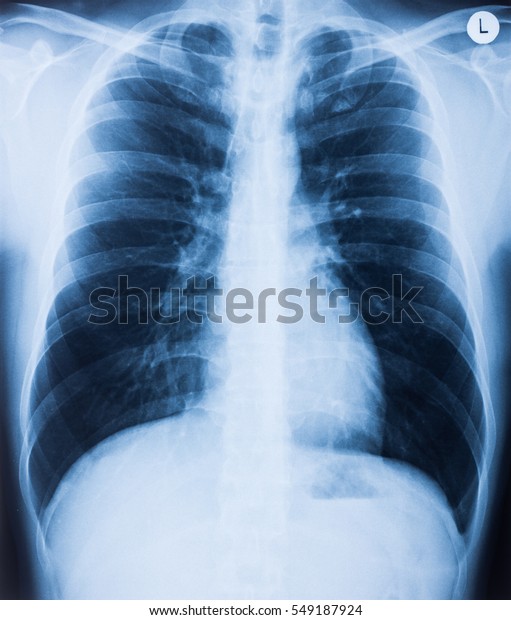 Xray Drawing Human Chest Front View Stock Photo (Edit Now) 549187924