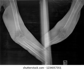 elbow humerus fracture