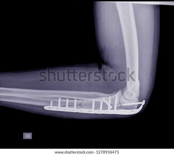 right elbow repair fx xray photo